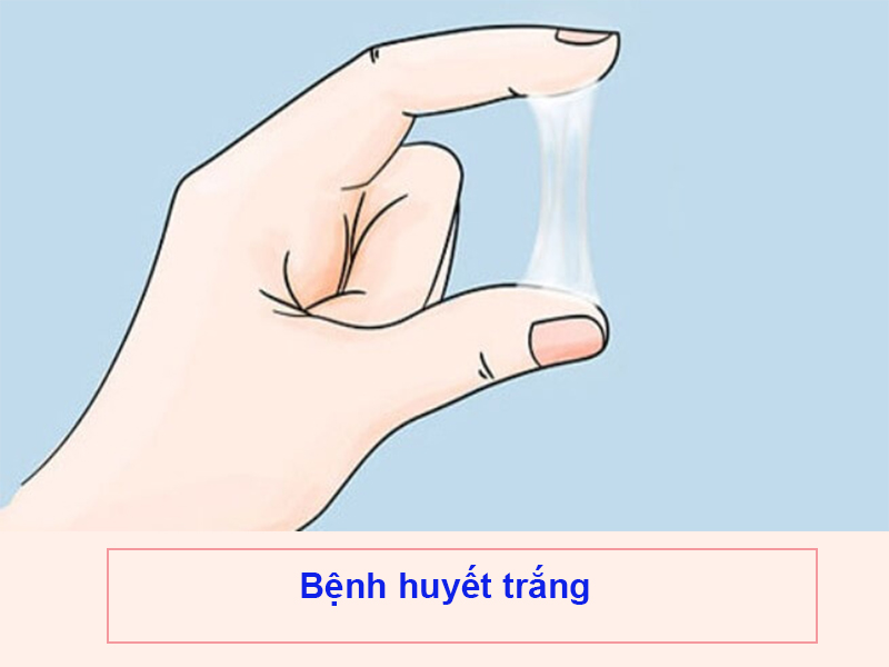 Bệnh huyết trắng