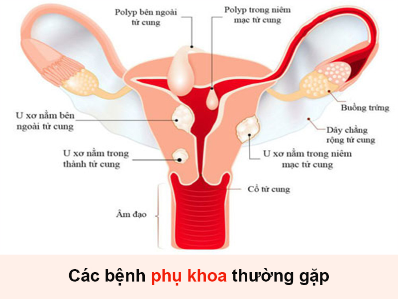 Một số bệnh phụ khoa thường gặp