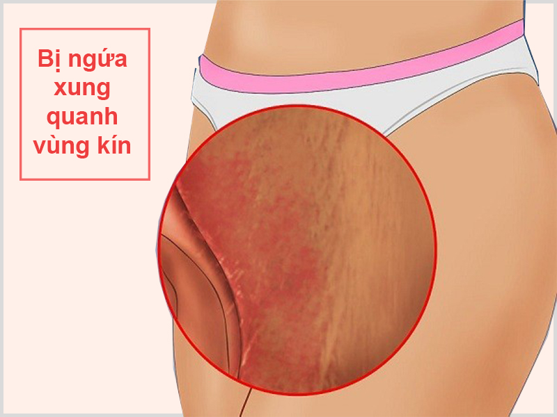 Bị ngứa xung quanh vùng kín