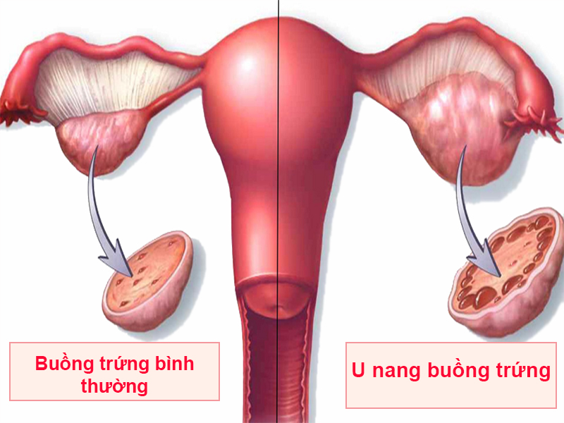 Hình ảnh: U nang buồng trứng