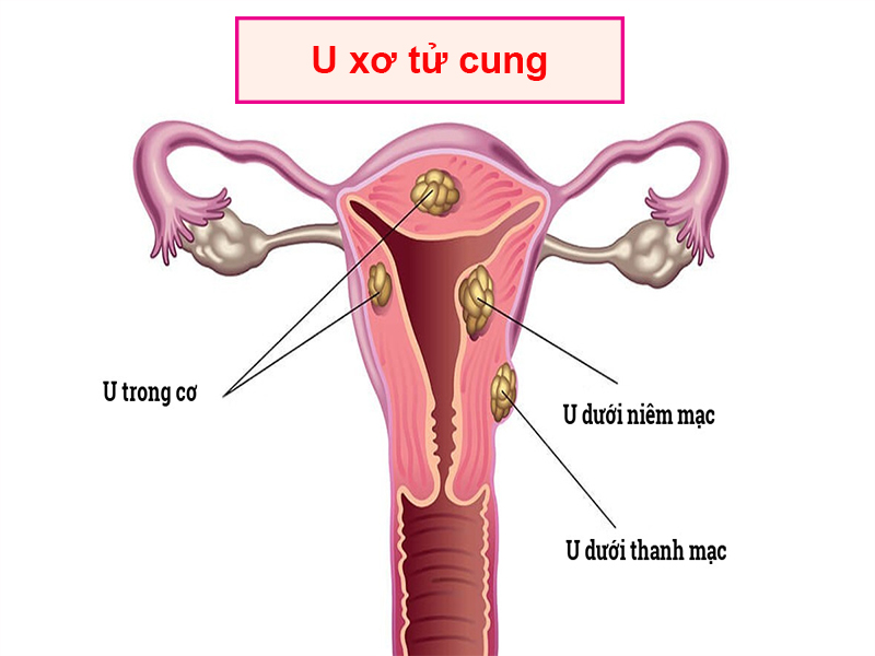Hình ảnh : U xơ tử cung