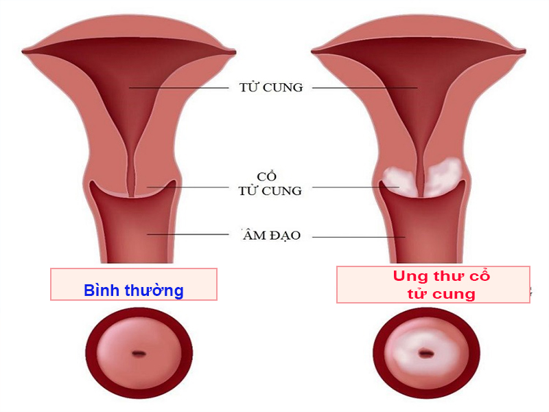 Hình ảnh: Ung thư cổ tử cung