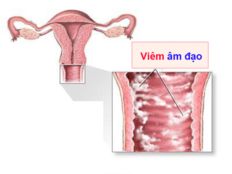 Viêm âm đạo