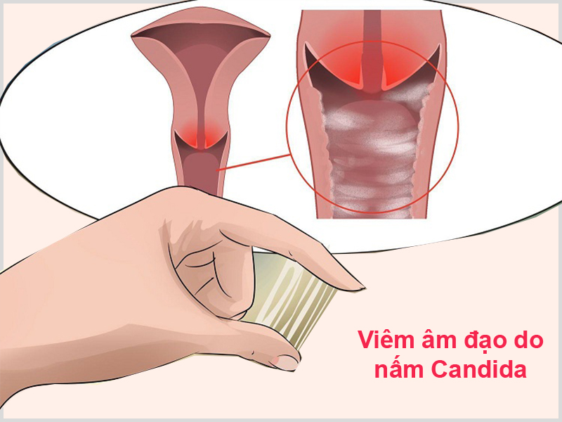 Hình ảnh: Viêm âm đạo do nhiễm nấm Candida