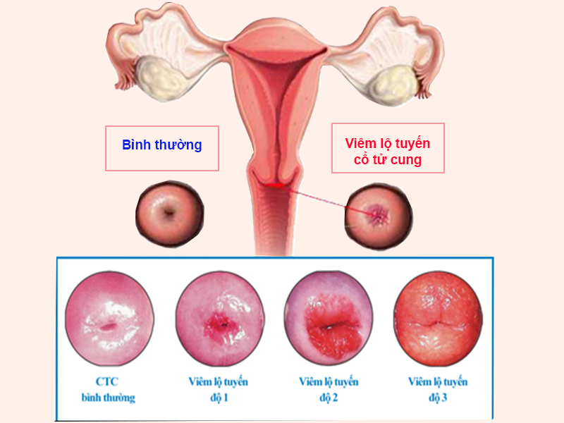 Viêm lộ tuyến cổ tử cung