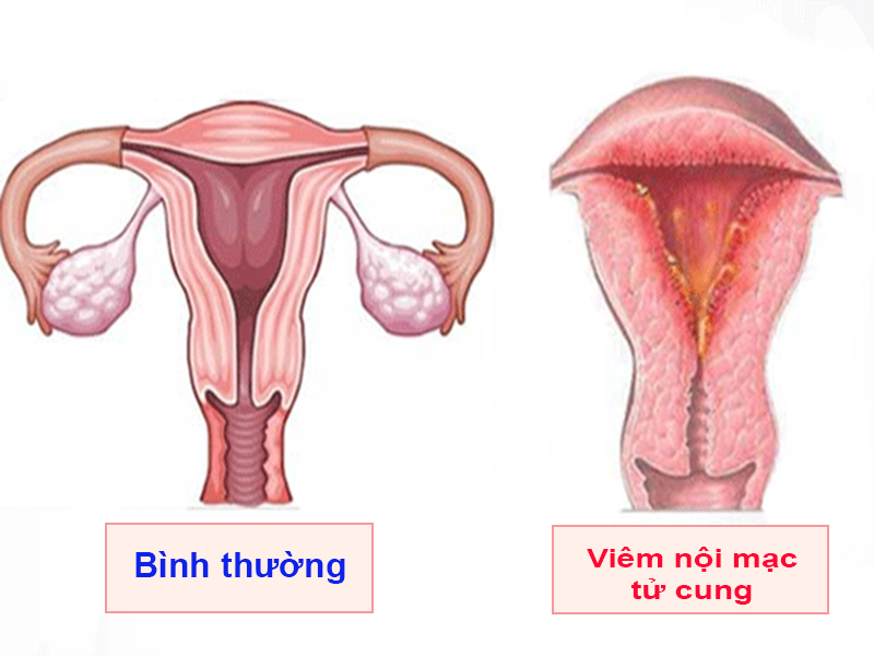 Viêm nội mạc tử cung