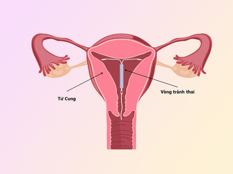 Phụ nữ chưa sinh con không nên đặt vòng tránh thai, do làm tổn thương tử cung sẽ ảnh hưởng đến khả năng sinh con sau này.