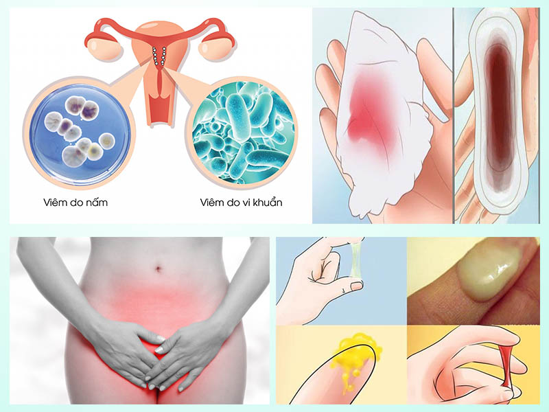Biểu hiện của viêm nhiễm phụ khoa