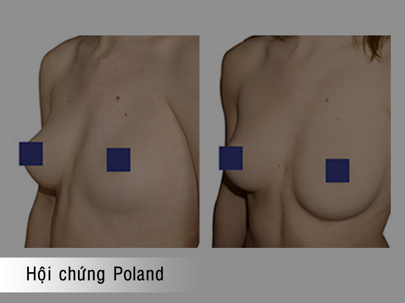 Hội chứng Poland gây lệch ngực