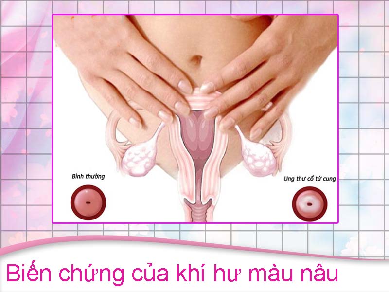 Biến chứng ung thư cổ tử cung