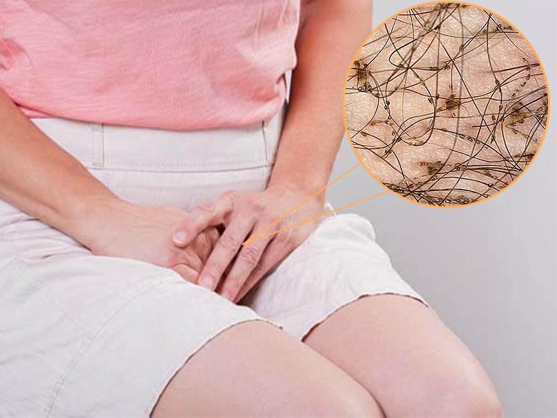 Dấu hiệu của rận lông mu