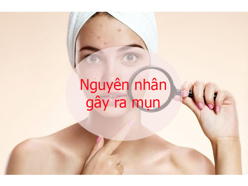 Nguyên nhân gây ra mụn