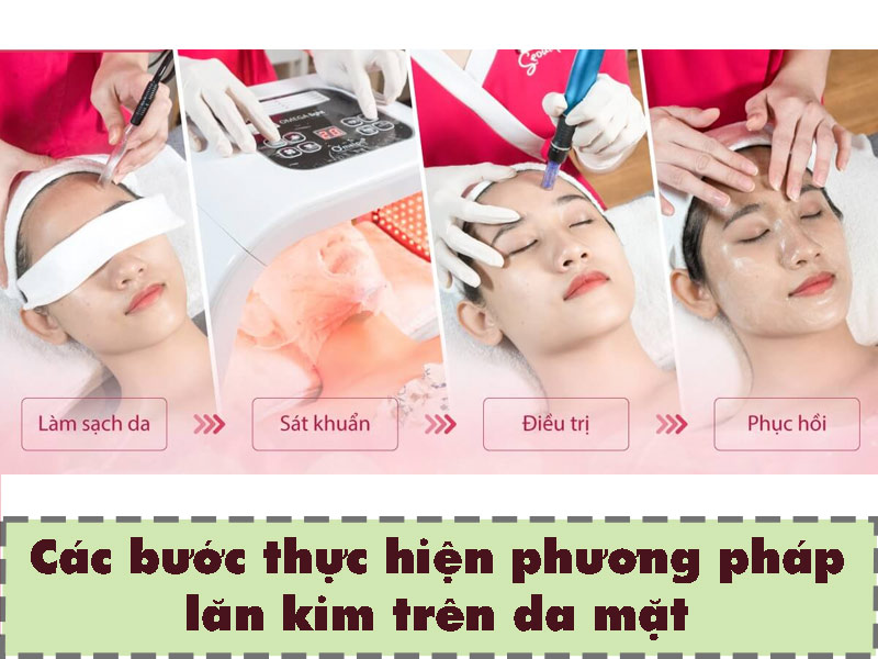 Quy trình thực hiện lăn kim trên da mặt