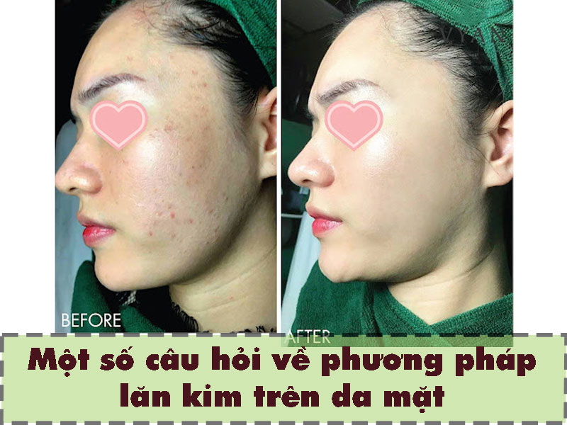 Một số câu hỏi thường gặp về phương pháp lăn kim