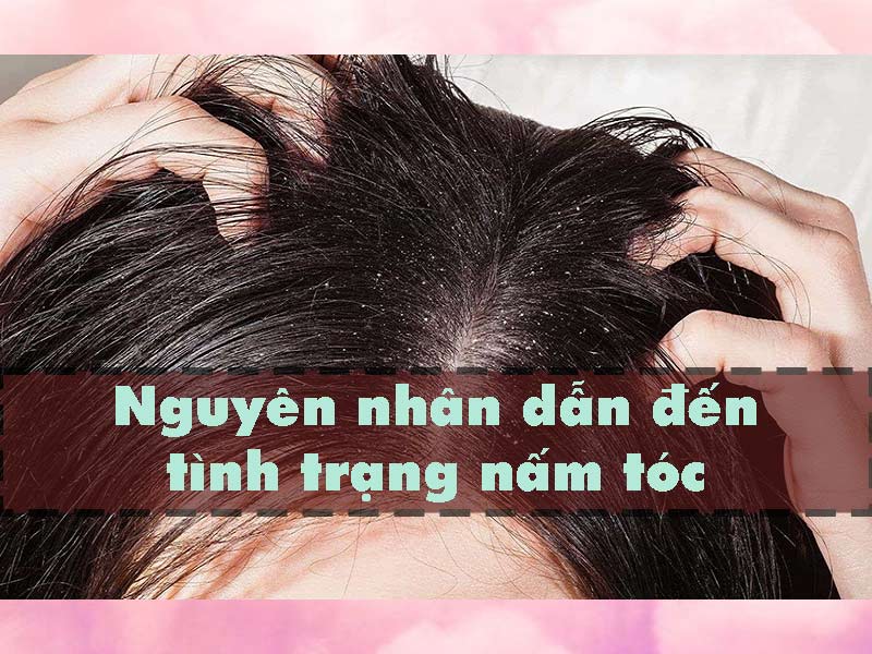 Nguyên nhân dẫn đến nấm da đầu